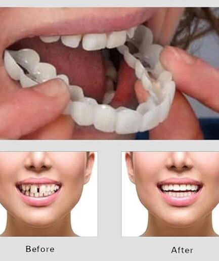 Snap On Smile - Veneers Teeth for Men and Women - Moldable False Artificial Braces Teeth